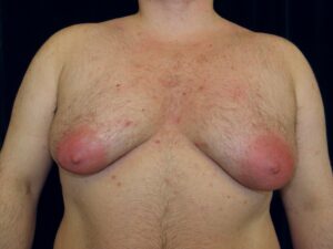 A patient at 18 years old