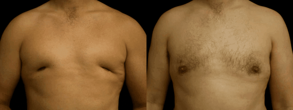 Patient with crater deformity with correction using "fat flaps".