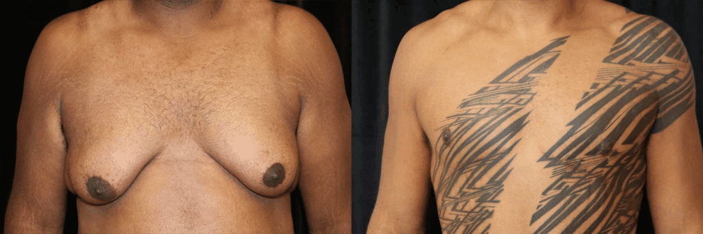 Patient with grade gynecomastia, photos of before and after male breast reduction surgery.
Note the tatoo hiding the incision.