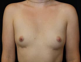 Patient after enbloc breast implant removal.