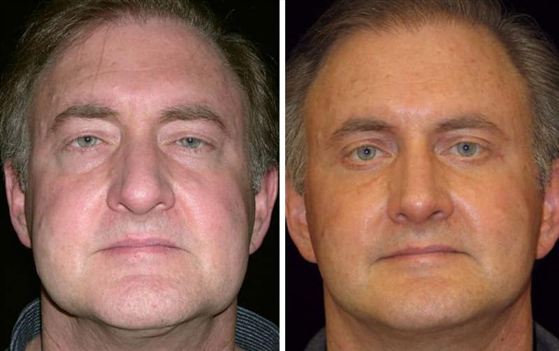 A patient of Dr. Delgado 6 months after a deep plane facelift, and upper and lower eyelid lift and buccal fat pad reduction.