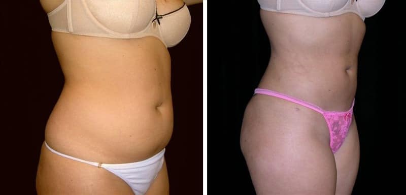 Before and after patient results 2