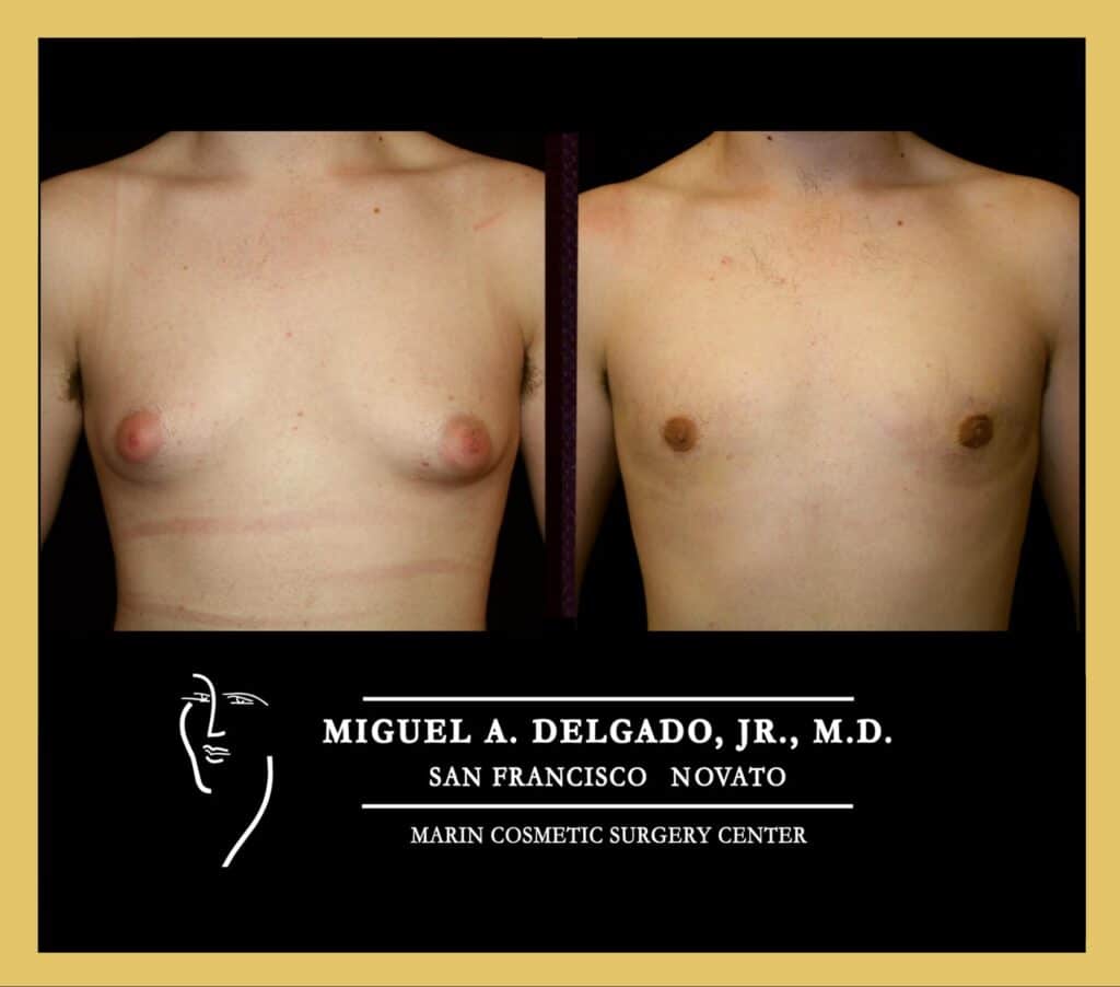 Before and after patient 2