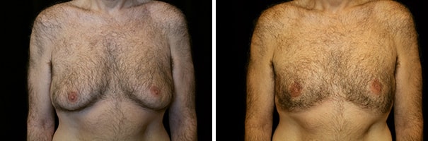 Before and after patient 4