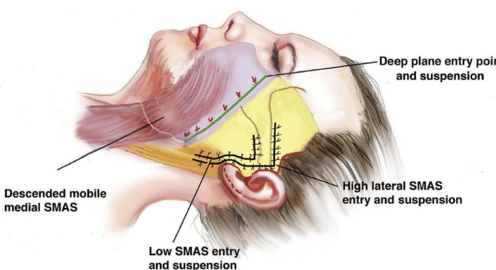 Deep plane facelift entry point vs SMAS facelift which offers a supeior lift for the mid- face and jowls.