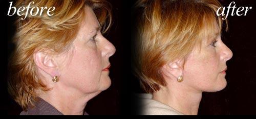 Before and after a deep plane facelift.