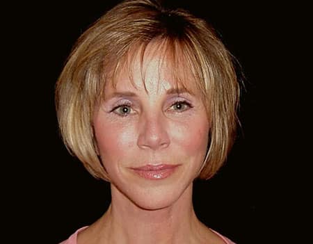 Janice one year after her deep plane facelift.