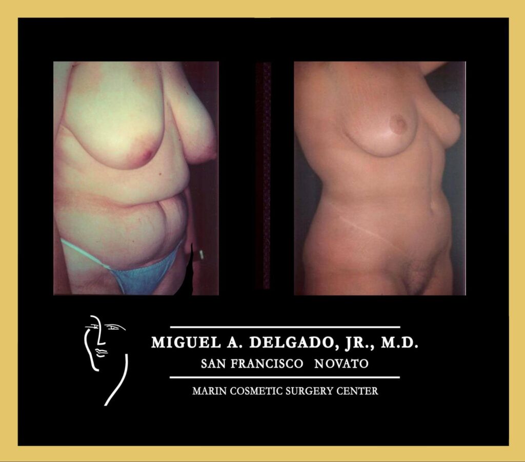 Mommy Makeover Patient Results