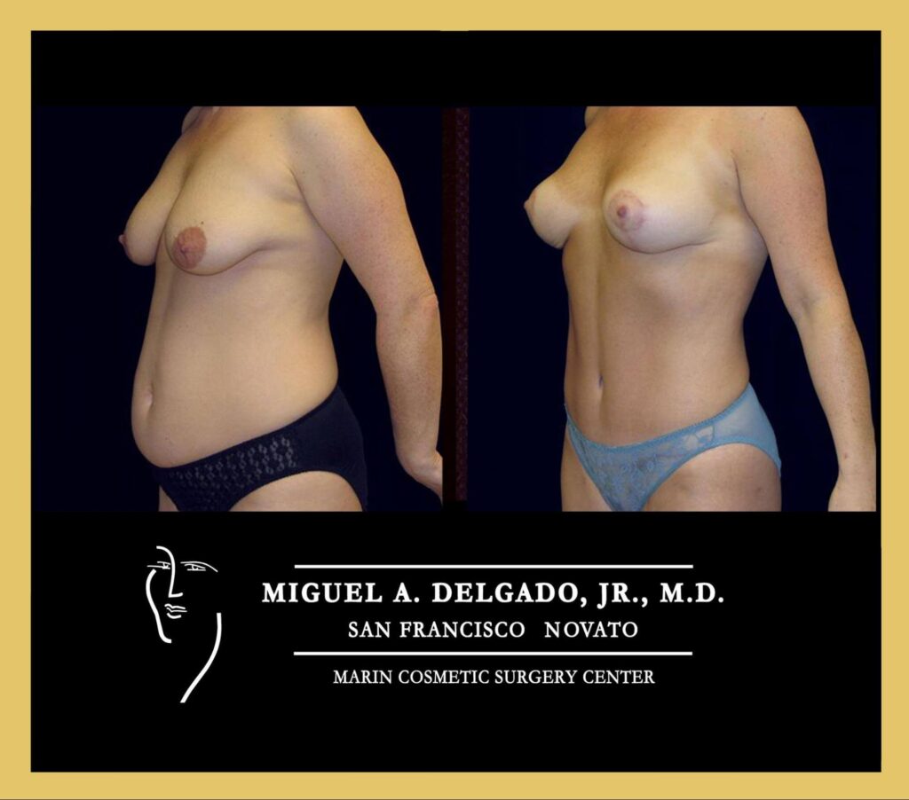 Mommy Makeover Patient Results
