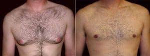 Gynecomastia before and after results