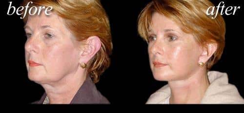 before and after