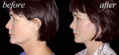 before and after