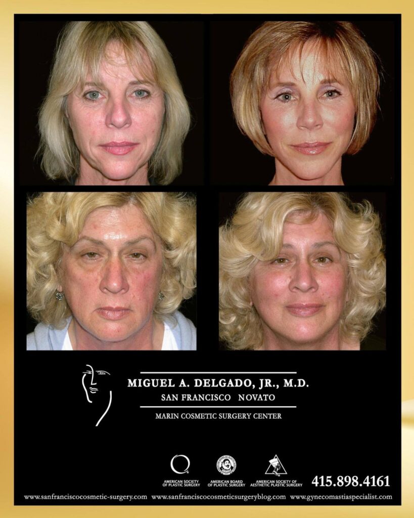 before and after