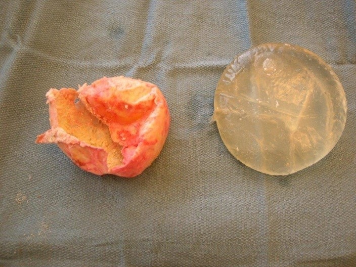 implants