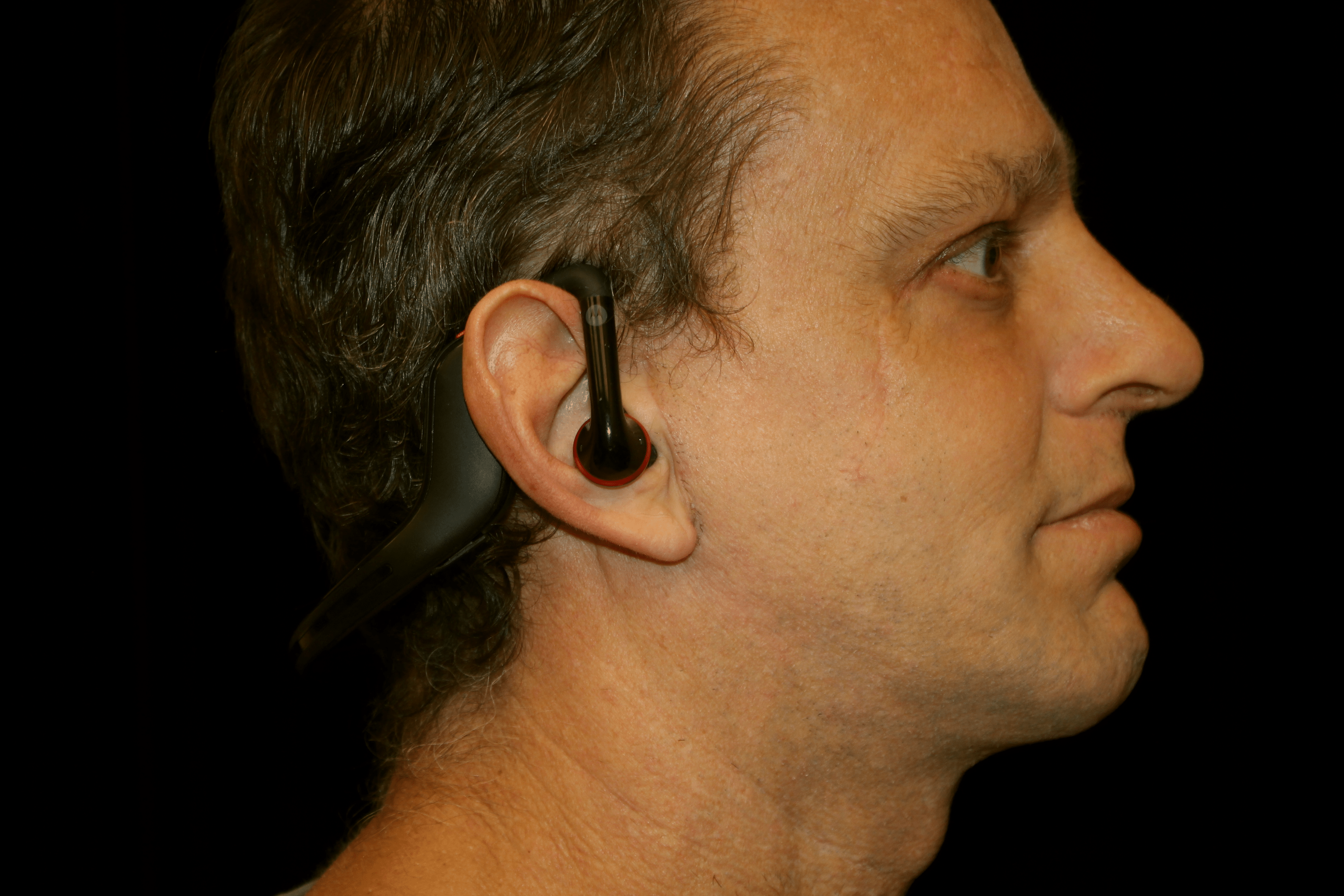 Napa Valley Patient after surgery at 4 months