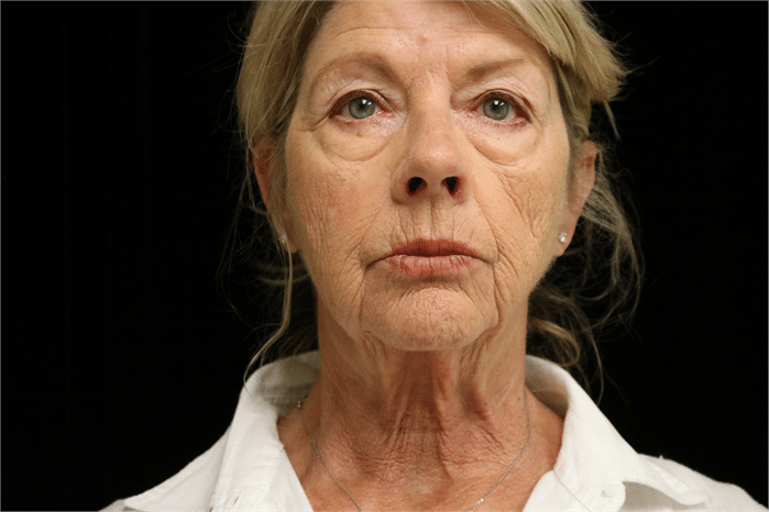 A patient of Dr. Delgado requesting complete facial rejuvination