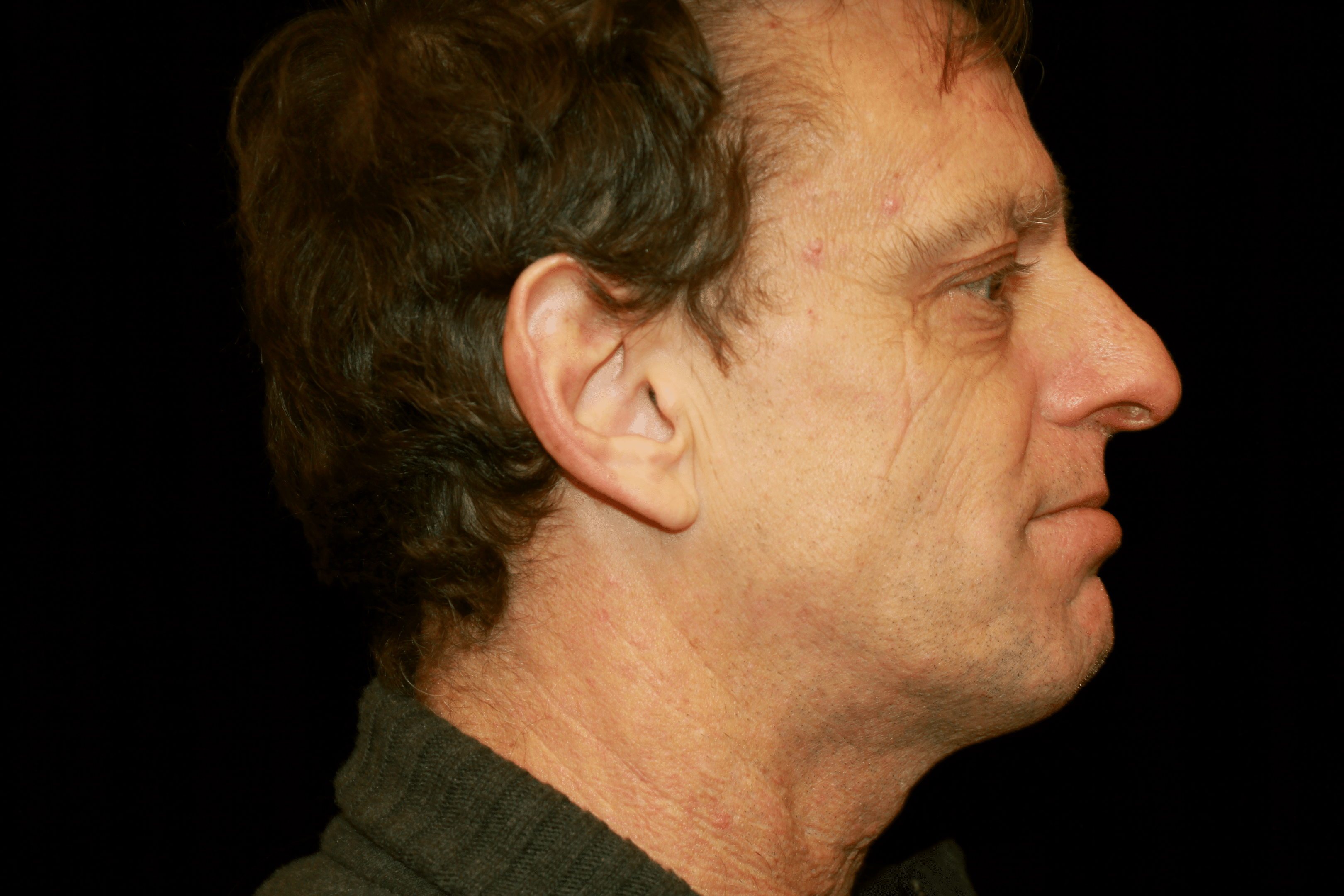 Male Face and neck lift eyelid lift browlift nose re-shaping chin implant and TCA chemical peel