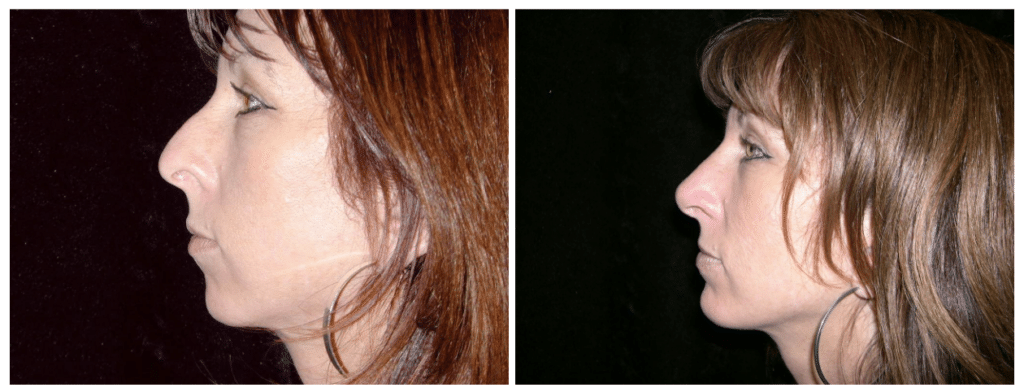 Before and after patient results